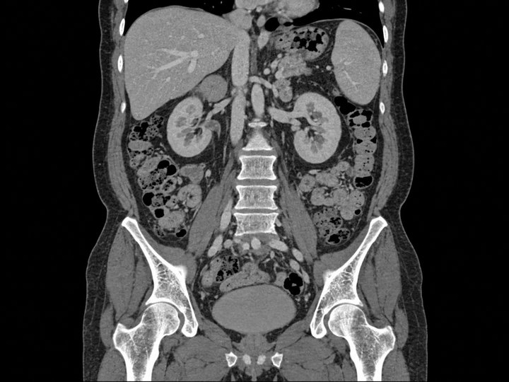 Illustration of a coronal abdomen and pelvis CT