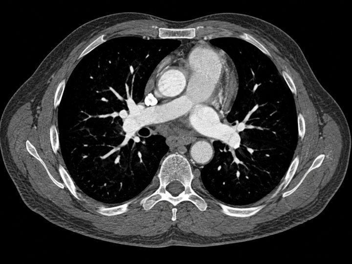 Illustration of an axial CT angiogram of the chest