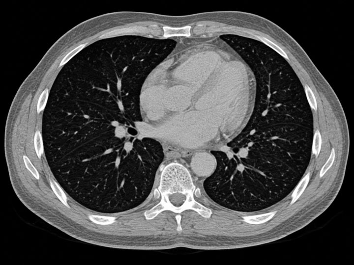 Illustration of an axial chest CT
