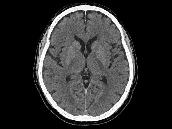 Illustration of an axial head CT