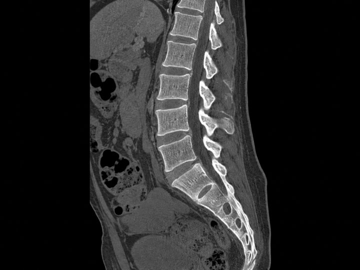 Illustration of a sagittal lumbar spine CT